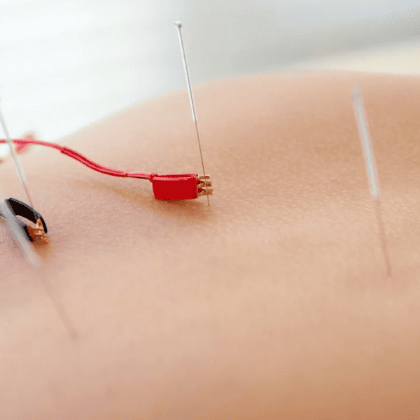 Иглоукалывание