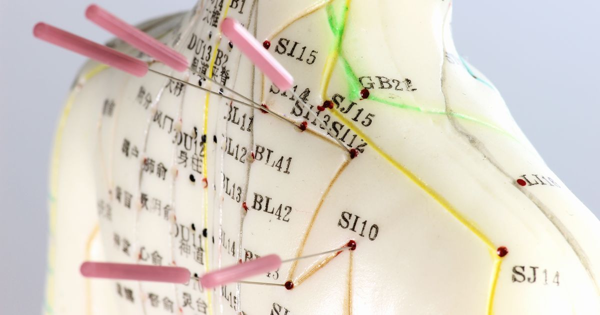 Acupuncture