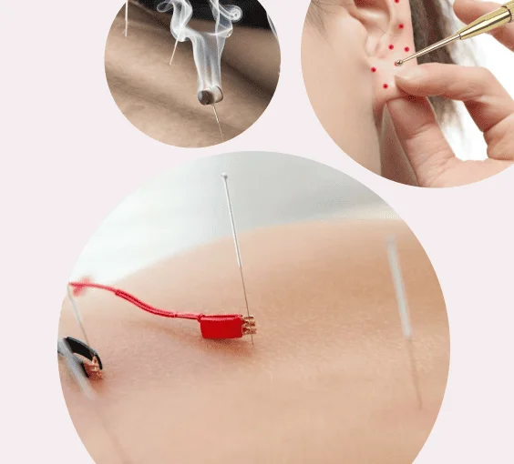 Acupuncture