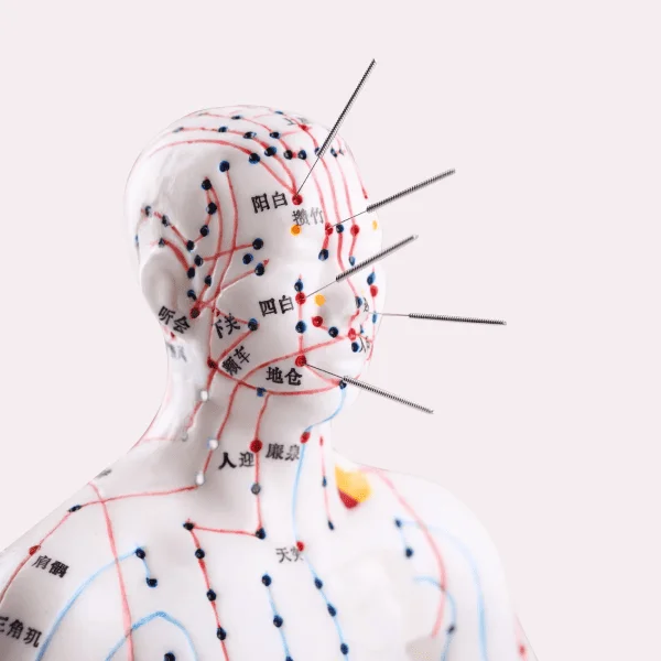 Acupuncture